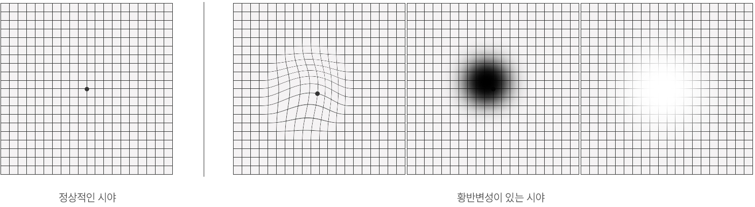 황반변성